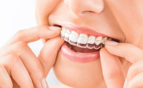 Invisalign Richmond